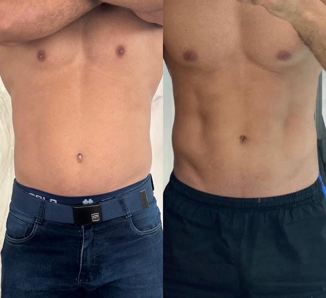 Resultado de Endolaser — Abdomen HD