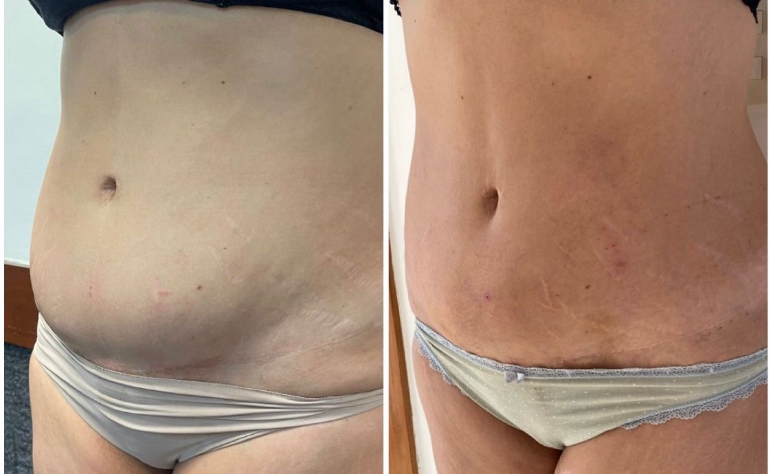 Resultado de Endolaser — Associação de Endolaser com ozonioterapia