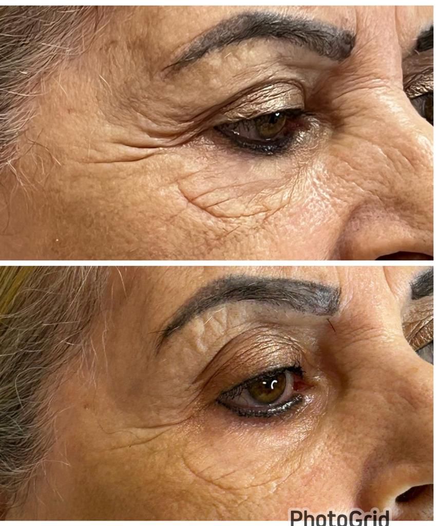 Resultado de Endolaser — Blefarolaser