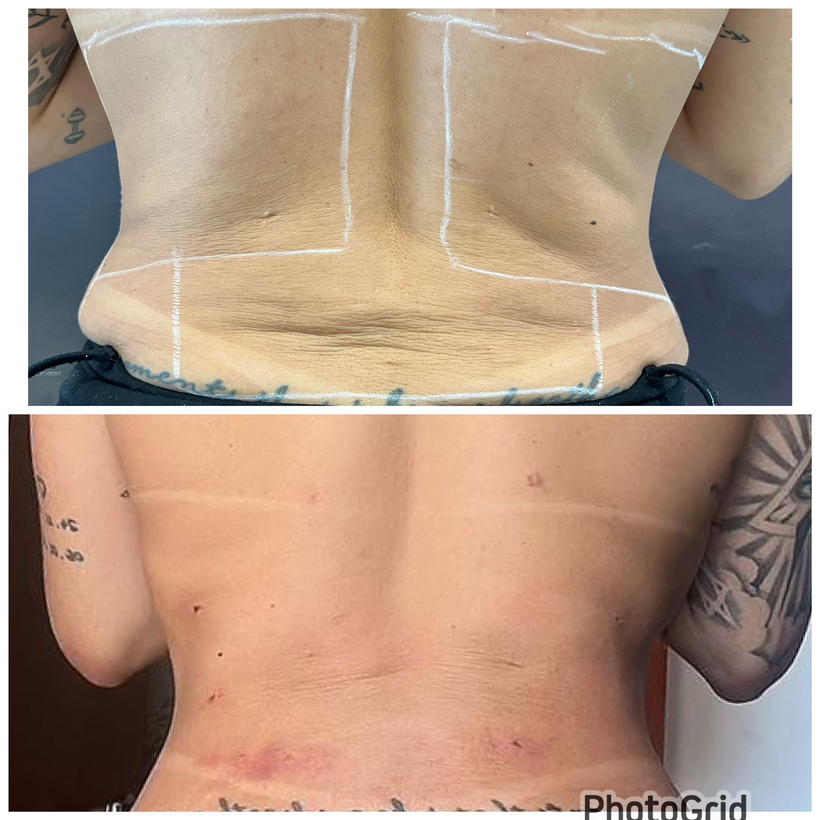 Resultado de Endolaser — Flacidez de dorso