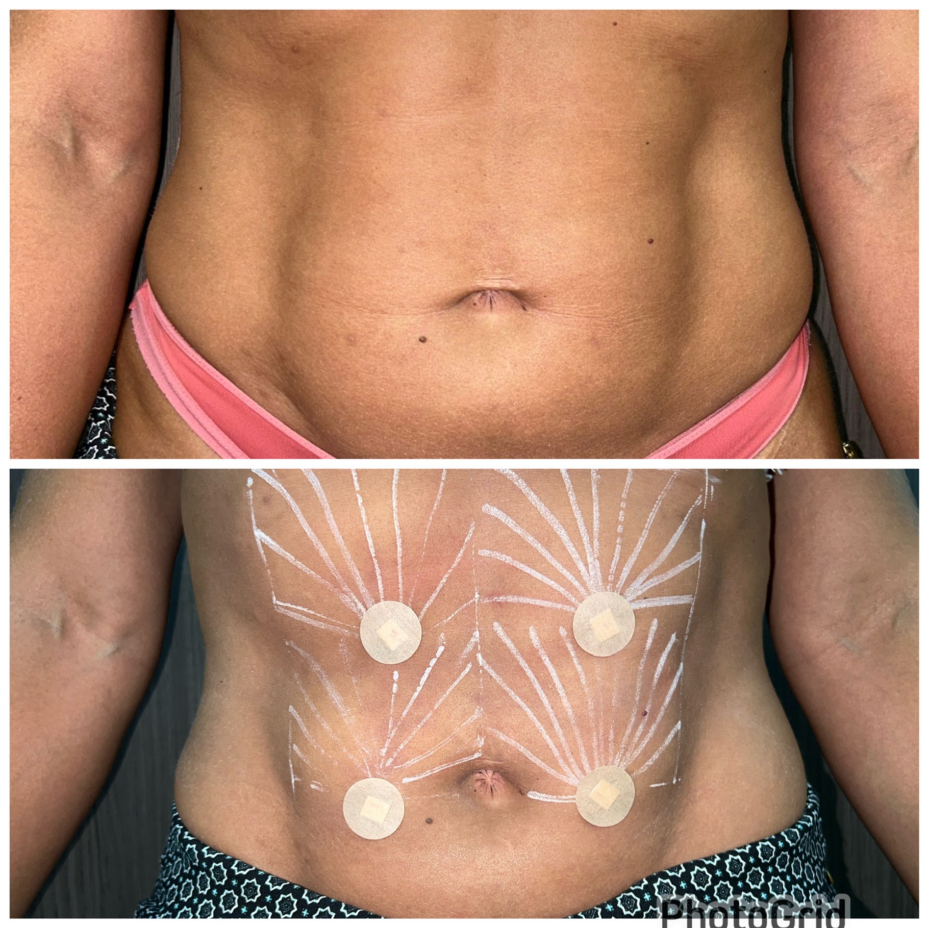 Resultado de Endolaser — Lifting de umbigo